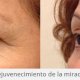 Rejuvenecimiento de la Mirada - Blefaroplastia - Dr. Gino Llosa