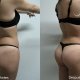 Gluteoplastía: Aumento de Glúteos - Dr. Gino Llosa