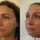 Lifting Facial por Video Endoscopía - Dr. Gino Llosa
