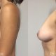 Mamoplastía Reductora - Dr. Gino Llosa