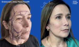 Pre y Post Endoscopic Deep Plane Facelift (Lifting Facial de Planos Profundos por Endoscopía) - Dr. Gino Llosa