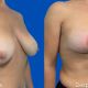 Mamoplastia Reductora - Dr. Gino Llosa