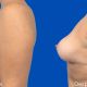 Mamoplastia Reductora - Dr. Gino Llosa
