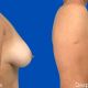 Mamoplastia Reductora - Dr. Gino Llosa