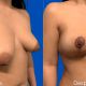 Mamoplastia Reductora - Dr. Gino Llosa