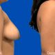 Mamoplastia Reductora - Dr. Gino Llosa