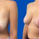 Mamoplastia Reductora - Dr. Gino Llosa