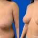 Mamoplastia Reductora - Dr. Gino Llosa